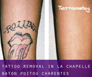 Tattoo Removal in La Chapelle-Bâton (Poitou-Charentes)