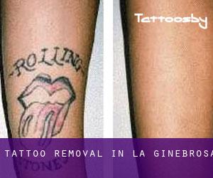 Tattoo Removal in La Ginebrosa