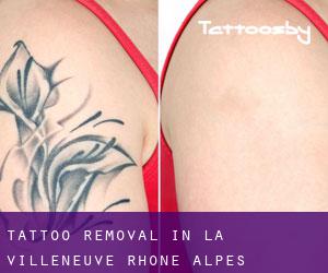 Tattoo Removal in La Villeneuve (Rhône-Alpes)