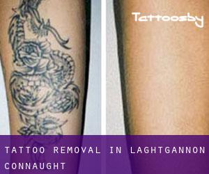 Tattoo Removal in Laghtgannon (Connaught)