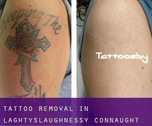 Tattoo Removal in Laghtyslaughnessy (Connaught)