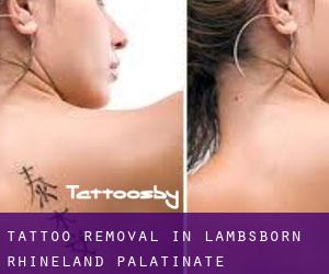 Tattoo Removal in Lambsborn (Rhineland-Palatinate)