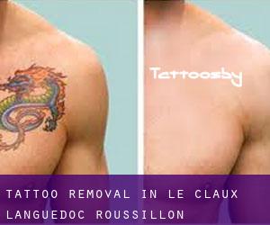 Tattoo Removal in Le Claux (Languedoc-Roussillon)