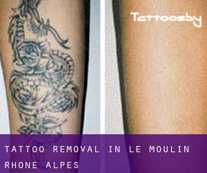 Tattoo Removal in Le Moulin (Rhône-Alpes)