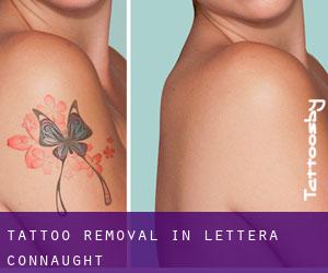 Tattoo Removal in Lettera (Connaught)