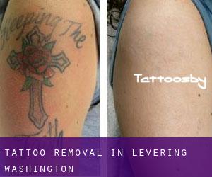 Tattoo Removal in Levering (Washington)