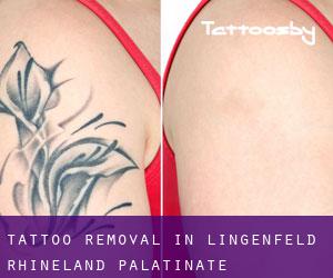 Tattoo Removal in Lingenfeld (Rhineland-Palatinate)