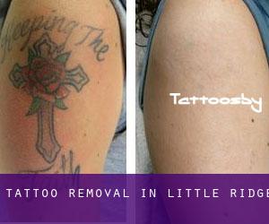 Tattoo Removal in Little Ridge