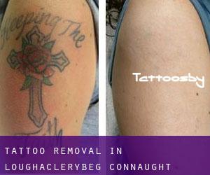 Tattoo Removal in Loughaclerybeg (Connaught)