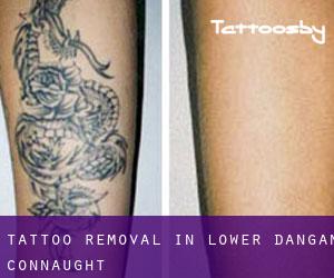 Tattoo Removal in Lower Dangan (Connaught)