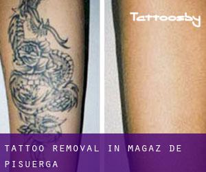 Tattoo Removal in Magaz de Pisuerga
