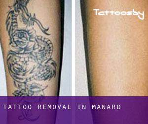 Tattoo Removal in Manard