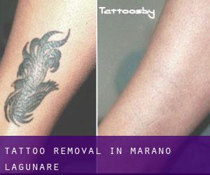 Tattoo Removal in Marano Lagunare