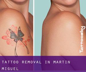 Tattoo Removal in Martín Miguel