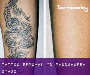 Tattoo Removal in Maungawera (Otago)