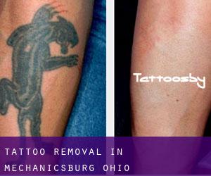 Tattoo Removal in Mechanicsburg (Ohio)