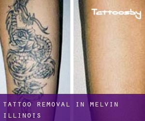 Tattoo Removal in Melvin (Illinois)