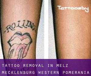 Tattoo Removal in Melz (Mecklenburg-Western Pomerania)