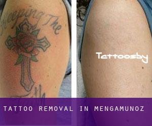 Tattoo Removal in Mengamuñoz