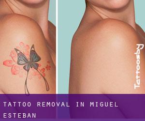 Tattoo Removal in Miguel Esteban