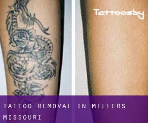 Tattoo Removal in Millers (Missouri)