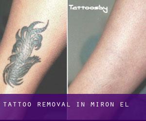 Tattoo Removal in Mirón (El)