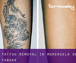 Tattoo Removal in Moreruela de Tábara