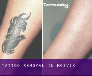 Tattoo Removal in Mosvik