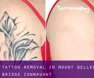 Tattoo Removal in Mount Bellew Bridge (Connaught)