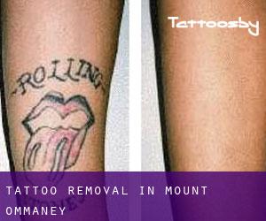 Tattoo Removal in Mount Ommaney