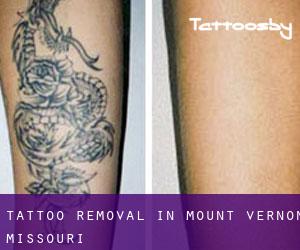 Tattoo Removal in Mount Vernon (Missouri)