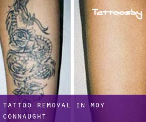 Tattoo Removal in Moy (Connaught)