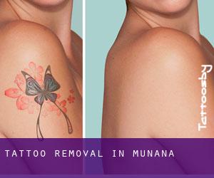 Tattoo Removal in Muñana