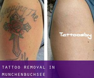 Tattoo Removal in Münchenbuchsee