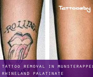 Tattoo Removal in Münsterappel (Rhineland-Palatinate)