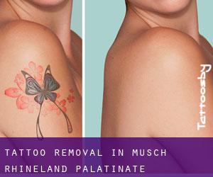 Tattoo Removal in Müsch (Rhineland-Palatinate)