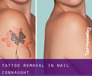 Tattoo Removal in Nail (Connaught)