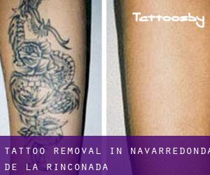 Tattoo Removal in Navarredonda de la Rinconada