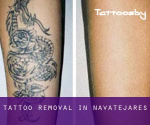 Tattoo Removal in Navatejares