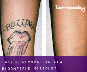 Tattoo Removal in New Bloomfield (Missouri)