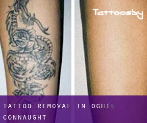 Tattoo Removal in Oghil (Connaught)