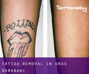 Tattoo Removal in Oraş Darabani