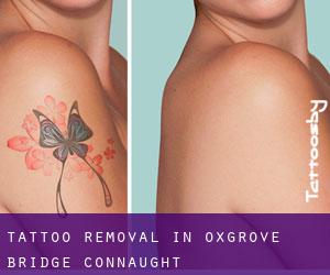 Tattoo Removal in Oxgrove Bridge (Connaught)