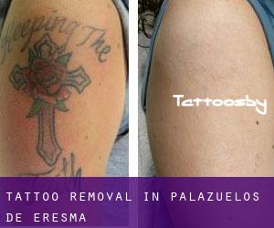 Tattoo Removal in Palazuelos de Eresma