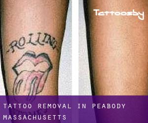 Tattoo Removal in Peabody (Massachusetts)