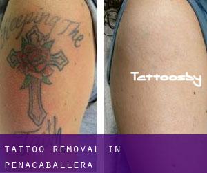 Tattoo Removal in Peñacaballera