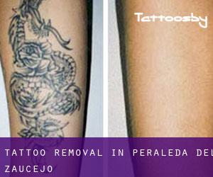 Tattoo Removal in Peraleda del Zaucejo