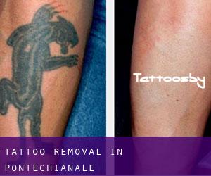 Tattoo Removal in Pontechianale