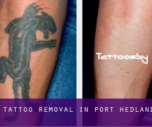 Tattoo Removal in Port Hedland