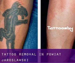 Tattoo Removal in Powiat jarosławski